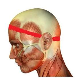 Tension Headache Pain Diagram