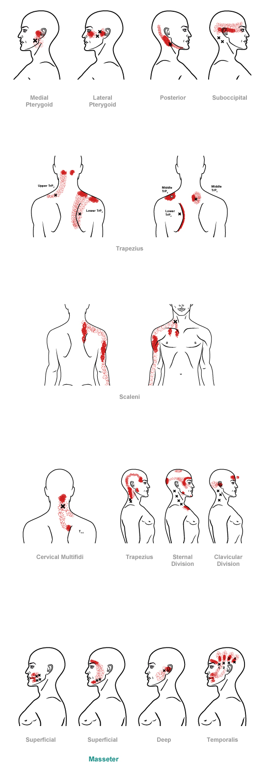 trigger point referral pain pattern for the head & neck