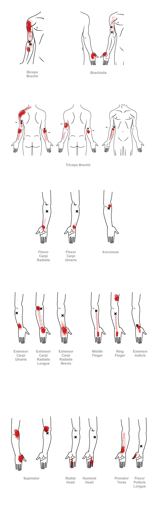 trigger point referral pain pattern for the elbow & forearm