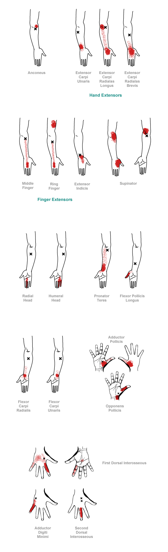 trigger point referral pain patterns for the hand & wrist