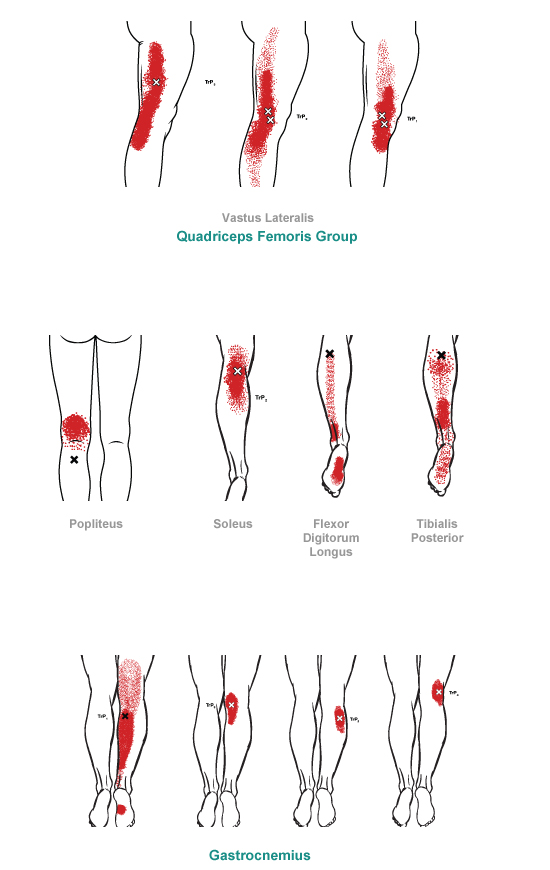 trigger point referral pain pattern for the knee & lower leg