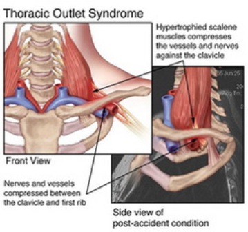 Thoracic outlet syndrome diagram courtesy of syndney essential health